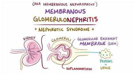 membranous glomerulonephritis causes.